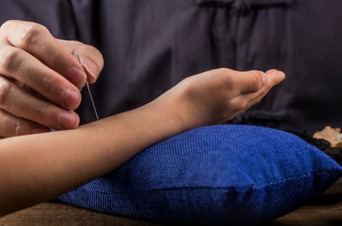 acupuncture therapy in Calgary